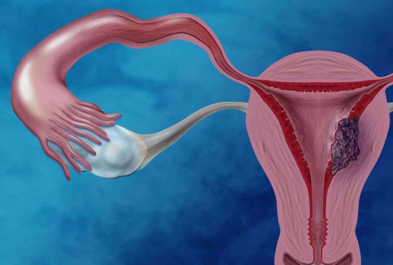 畸形子宫会导致胎儿出现臀位