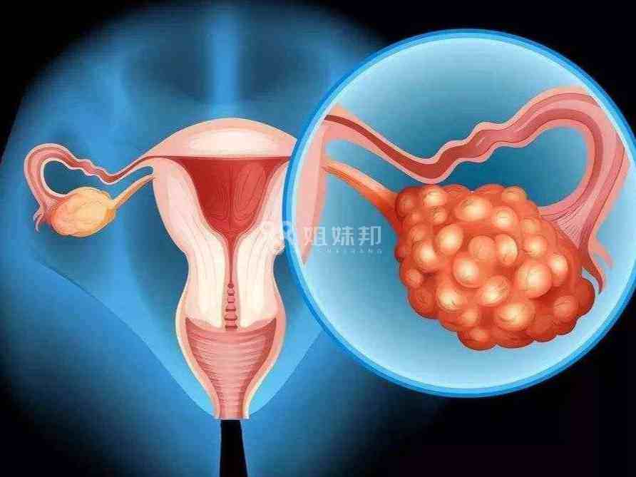 卵巢病变会影响卵泡发育不良